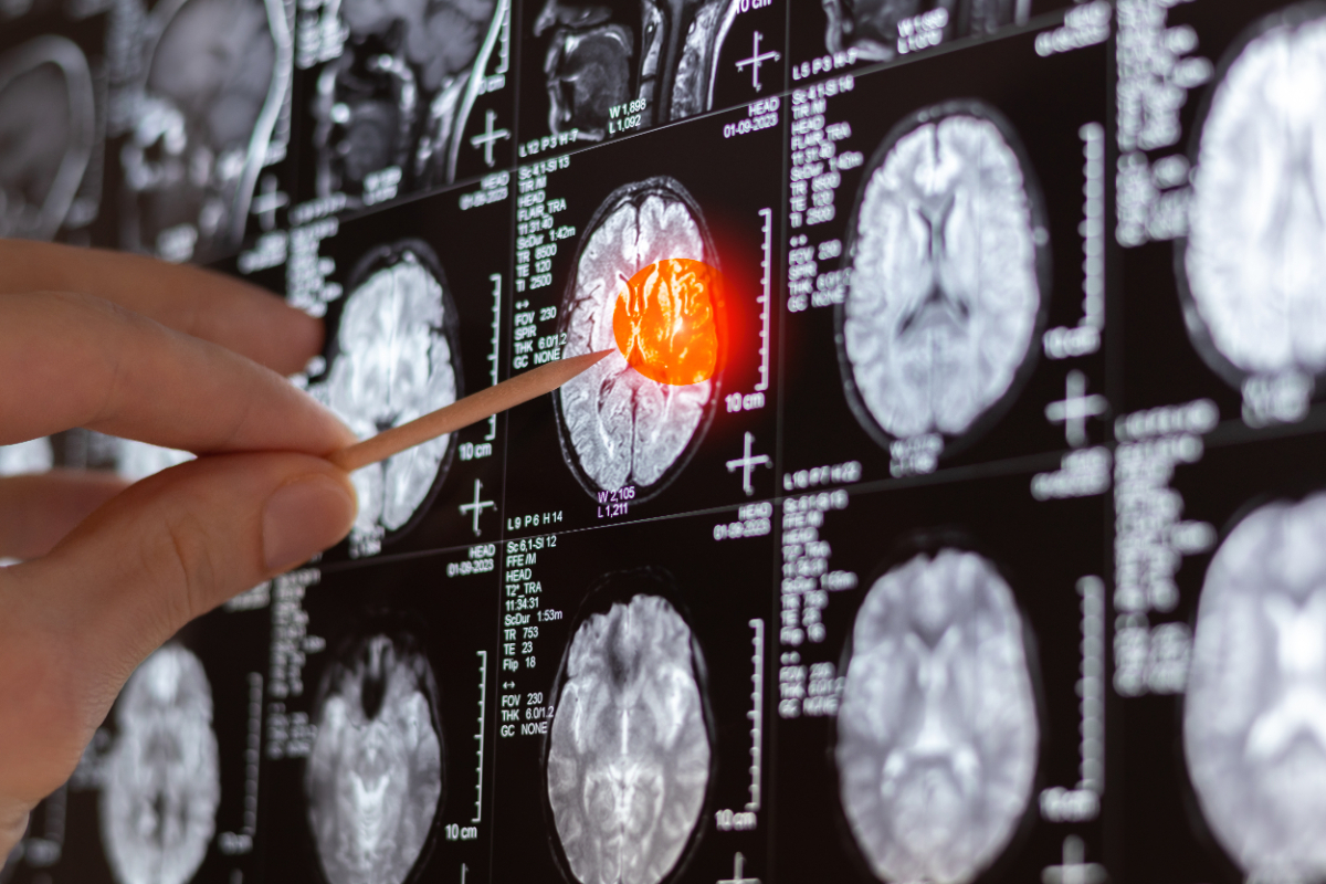 Doctor examining MRI, MRT, CT scan image of human brain. Medical treatment concept. Diagnosis of the disease humans head. Close up.